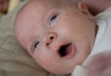Сыпь на лице у грудничка: ее разновидности, причины и лечение