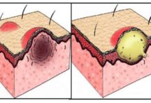 Что такое папула и пустула: виды высыпаний на коже, лечение медикаментами и народными средствами