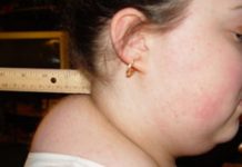 Жировик на шее: фото, причины и быстрое лечение