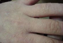 Сыпь на руках в виде маленьких прыщей, чешется, фото
