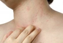 Сколько сходит аллергическая сыпь