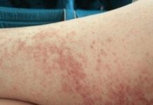 Сыпь на ногах чешется: чем лечить и как снять зуд