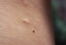 Пятна после удаления родинки: виды и их значения