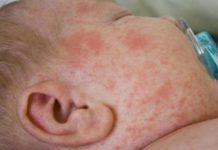 Крапивница у детей — причины и проявления, симптомы и лечение болезни