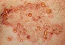 Водянистые пузырьки на коже чешутся — узнать подробнее