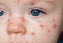 Сыпь на теле у ребенка, фото с пояснениями