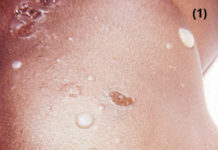 Сыпь у ребенка ( фото): сыпь на лице, на теле, причины сыпи — НаПоправку – НаПоправку