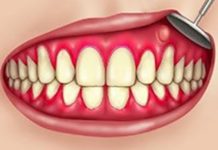 Нарыв на десне – Что делать, если нарывает десна – стоматологический портал