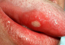 Абсцесс на языке – чем опасен гнойник во рту и как его удалить