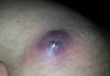 Гнойник в паху: почему появляются и как лечить