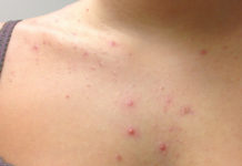 Зона особого внимания: акне на спине и в зоне декольте