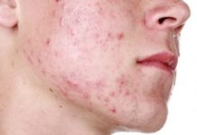 Гнойники на лице: как эффективно вылечить неприятные прыщи