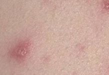 Сыпь на теле у взрослого фото с пояснениями что это может быть