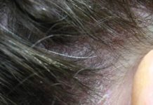 Акне на голове: лечение и причины, фото