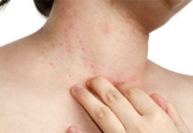 Сыпь и пятна на теле на нервной почве (аллергия, крапивница, с фото)