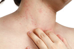 Сыпь и пятна на теле на нервной почве (аллергия, крапивница, с фото)