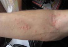 Сыпь на плечах и предплечьях в виде прыщей: фото и причины