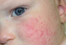 Диагностика аллергической сыпи у детей, профилактика и лечение