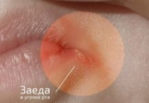 Заеды в уголках рта у детей: причины и лечение (16 фото): чем лечить ангулит и какими кремами мазать ангулярный хейлит, стоматит