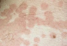 Сыпь при онкологии фото на теле, прыщи и зуд при раке: причины, симптомы, как выглядит и почему чешется