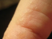 Водянистые прыщи на пальцах рук и ладонях: причины, методы лечения и профилактики |