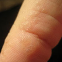 Водянистые прыщи на пальцах рук и ладонях: причины, методы лечения и профилактики |