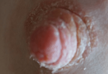 Что делать, если появляются пупырышки на сосках?