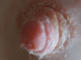 Что делать, если появляются пупырышки на сосках?