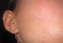 Аллергия на лице (отёк и пятна): что делать и как избавиться 2020