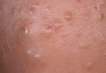 После массажа сыпь на спине, лице и ногах: что делать, если появились прыщи? |