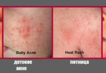 Почему на голове у грудничка могут появляться прыщики