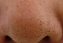 Чёрные точки на лице у грудничка: причины появления и что делать | ru-babyhealth