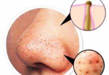 Как можно избавиться от черных точек быстро и эффективно?