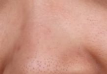 Черные точки у ребенка: на лице, голове, под мышками