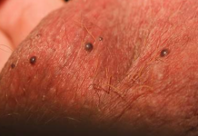 Черные точки на яичках у мужчин — фото, причины, лечение