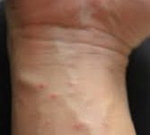 Чесотка: фото, симптомы