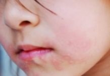 Сыпь вокруг рта у ребенка, раздражение (22 фото): причины высыпаний возле рта, сыпь при ротовирусе