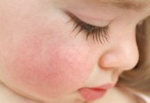 Красные щеки и сыпь на теле у ребенка: это аллергия или инфекция? | Блог Medical Note о здоровье и цифровой медицине