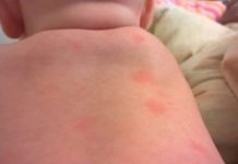 Сыпь на спине у ребенка: фото с пояснениями, из-за чего, к какому врачу обратиться