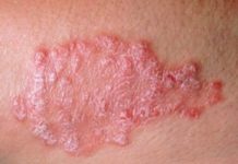Дерматит: фото, симптомы и лечение у взрослых в домашних условиях