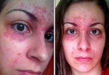 Сыпь при остром и хроническом панкреатите