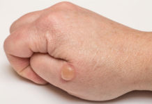 Диабетическая пузырчатка