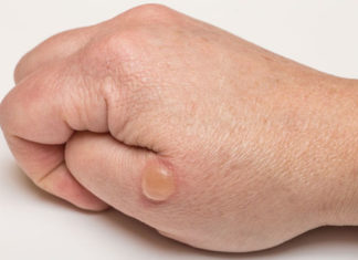 Диабетическая пузырчатка