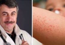 Доктор Комаровский про сыпь у ребенка: причины появления на теле и лице, ладошках, вокруг рта, на попе – что делать