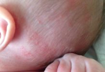 Прыщи на голове у ребенка — гнойные, красные, водянистые, чем помазать, лечение, причины