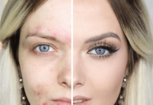 Серная мазь от прыщиков