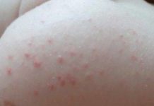 У ребёнка прыщи с белой головкой у анального отверстия — Вопрос дерматологу — 03 Онлайн