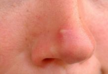 Гнойный прыщ на носу (гнойники) — как лечить, причины, у взрослых, при беременности, у ребенка