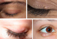 2 Вида жировиков на веке,на глазу и вокруг них, как избавиться