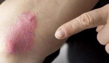 Псориаз на локтях: чем лечить и как от него избавиться на начальной стадии лекарствами из народной медицины и чем мазать при возникновении ранок